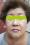 정안침 시술사례(5회 시술 후)